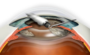 Повторная замена хрусталика