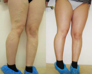 Отек внутренней стороны бедра и варикоз