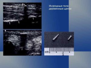 Как выявить инородное тело (деревянные палки) в мышцах?