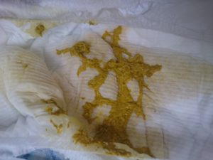 Ребенок 5 лет стал часто какать