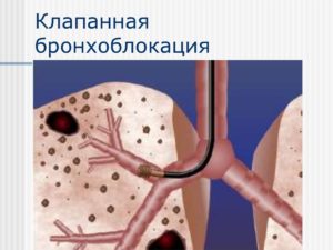 Последствие бронхоблокатора