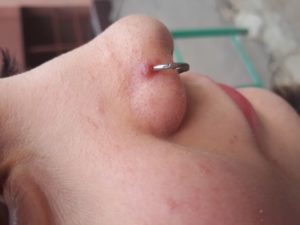 Образование шишки на месте прокола носа