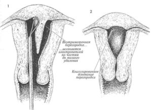 Перегородка в матке