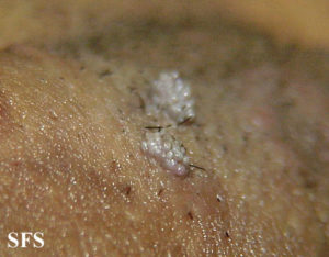 Нарост около анального размера немаленького размера