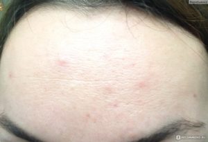 Помогите! Лицо обсыпало прыщами