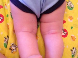 Появились несимметричные складочки в 7 месяцев