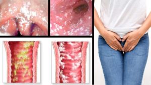 Гормональная молочница