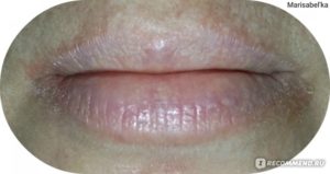 Шелушится кожа в уголках рта