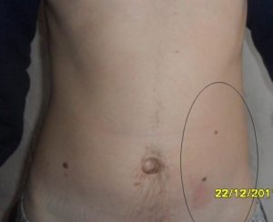 Твердый живот справа возле пупка и внизу