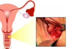 Сужается ли влагалище при отсутствии секса