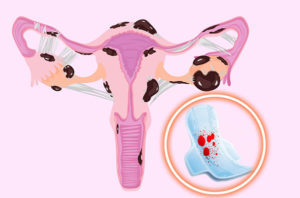 Задержка при эндометриозе