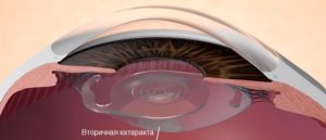 Повторная замена хрусталика