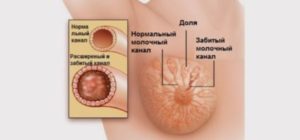 Комки в груди при грудном вскармливании