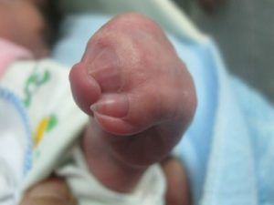 Красная крайняя плоть у ребенка