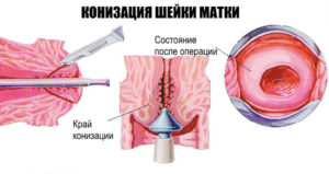 Выделения после эксцизии шейки