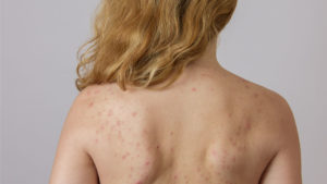 Прыщи и сыпь на спине после массажа