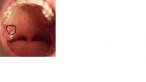 На миндалине появилось белое пятно