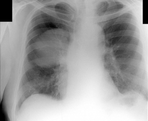 Уплотнение плевры после воспаления лёгких