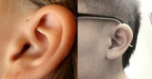 Околоушный свищ