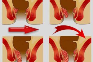 Аксонопатия в запущенной стадии. Можно ли ее вылечить?