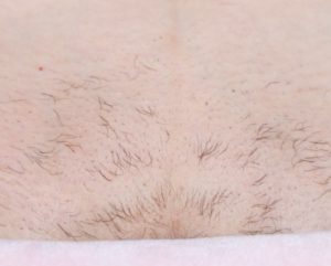 Перестали расти волосы посередине лобка