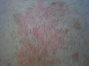 Красные пятна на лобковой части, чешутся и шелушатся