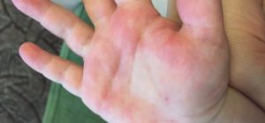Высыпания на ступнях и ладонях, нёбе