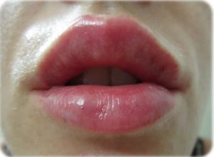 После увеличения губ появились точки