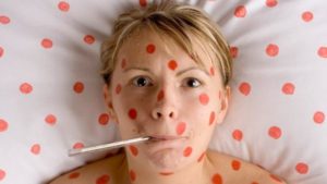 Алкоголь при ветрянке на 12 день