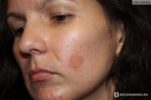 Ожог лица салициловой кислотой