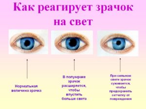 Глаз тровмирован, зрачок расширен, плохо реагирует на свет