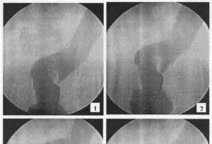 Нащупала что-то в прямой кишке