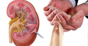 Песок в почках