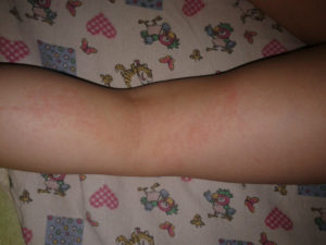 Сыпь на бедре у ребёнка