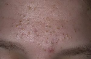 Болючие внутренние прыщи и закрытые комедоны на лице