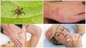 Болезненные шишки после укуса клеща