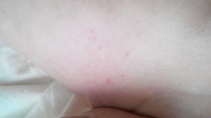 У ребенка прыщики в паху