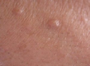 Уплотнение под кожей возле головки