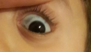 У ребенка на белках глаза серые пятна