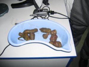 После клизмы нет стула 5 дней