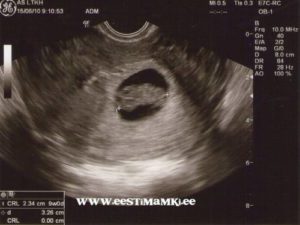 Перестала болеть грудь на 9 неделе беременности