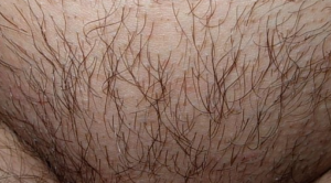 Перестали расти волосы посередине лобка