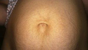 Боль в пупке после родов