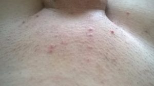 У ребенка прыщики в паху