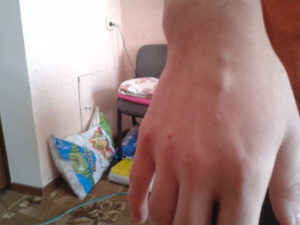 Пульсирующий шарик на вене