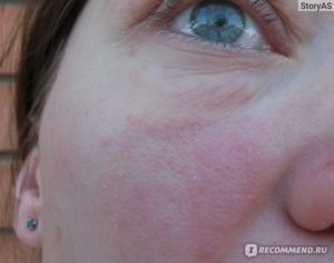 Высыпание на коже при перегибе желчного пузыря