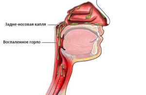 Стекает гной по носоглотке