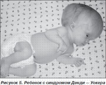 Синдром денди уокера у детей
