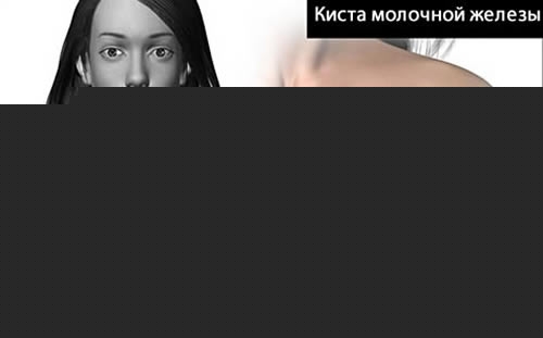 Симптомы кисты молочной железы