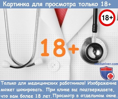 Опухоль околоушной слюнной железы